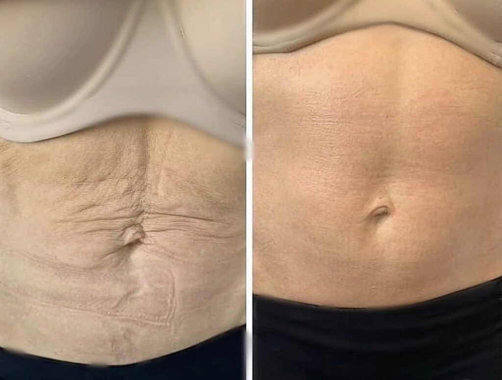 A side-by-side comparison of a lower abdomen with loose skin on the left and a smoother stomach on the right, shown against a light top and dark waistband.
