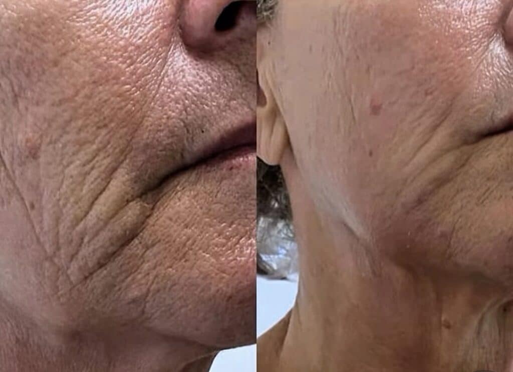 Split close-up of an older adult's lower face and jawline, showing skin texture and wrinkles, with the left side appearing more lined than the right.