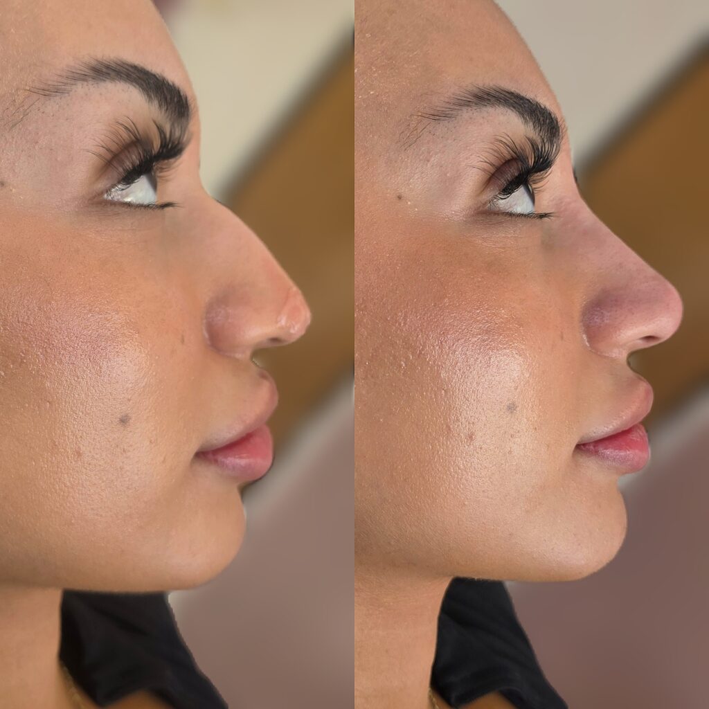 Side-by-side profile photos of the same woman with dark hair, shown against a blurred indoor background.
