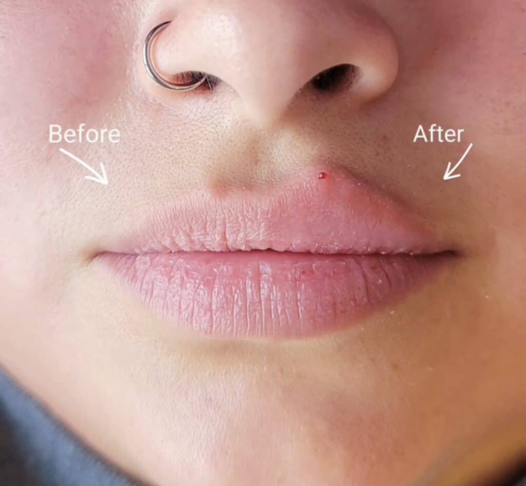 Close-up of a nose and lips with a silver septum ring and a small red spot above the upper lip, labeled before and after.