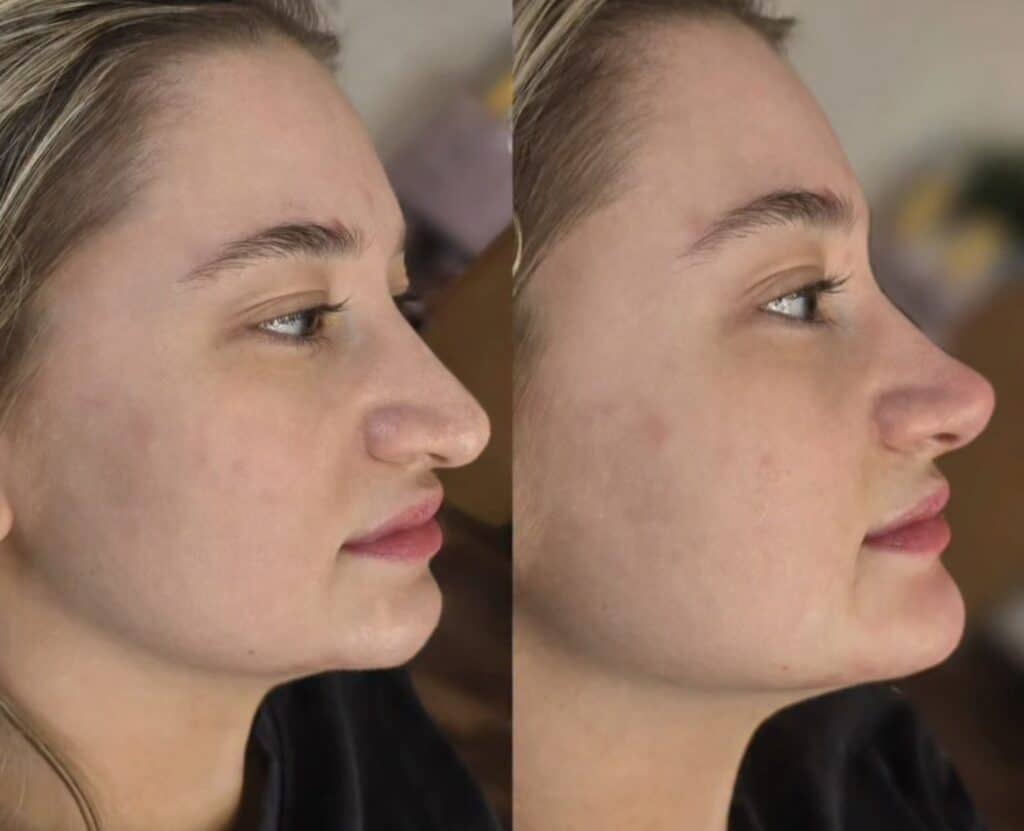 Side-by-side profile photos of a young woman with pulled-back hair, shown against a softly blurred indoor background.