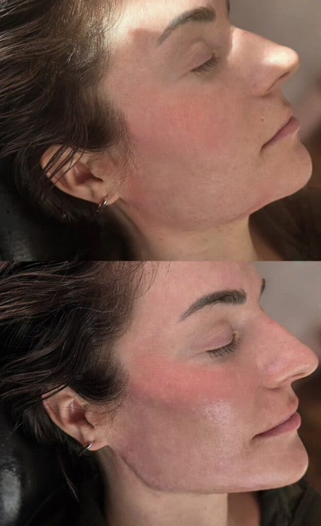 Two side-profile photos of a woman with dark hair and a small hoop earring, showing redness and improved skin tone on her cheek and jawline.