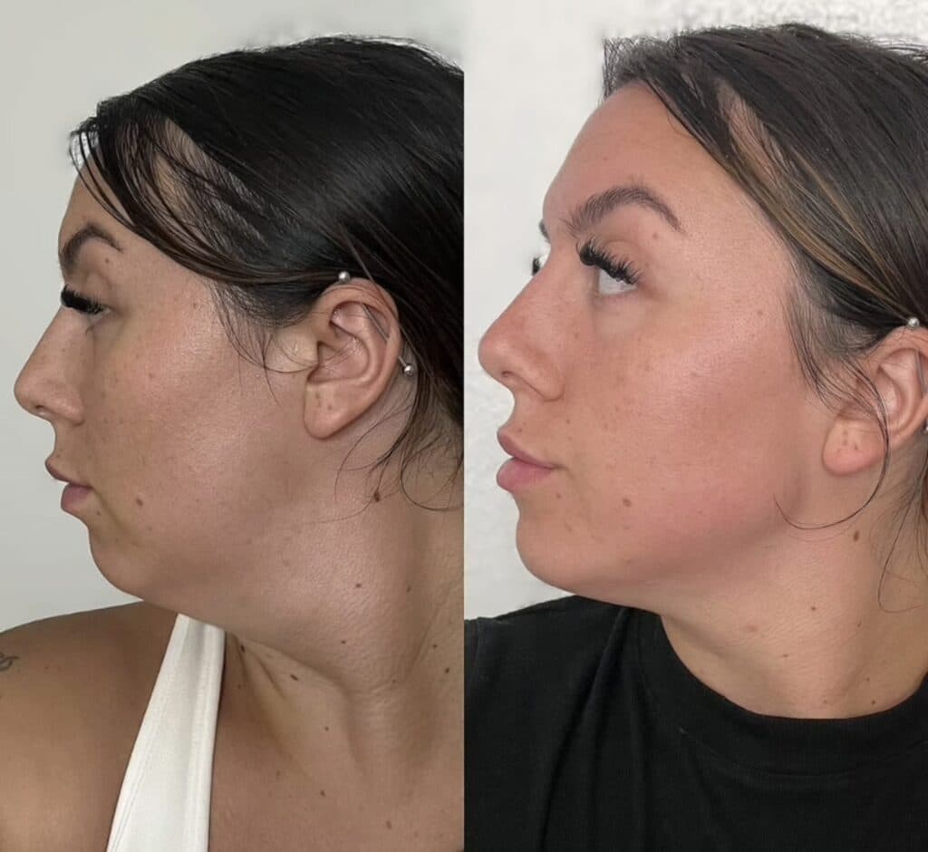 Side-by-side profile photos of the same woman against a plain background, showing a before-and-after comparison with different clothing and makeup.