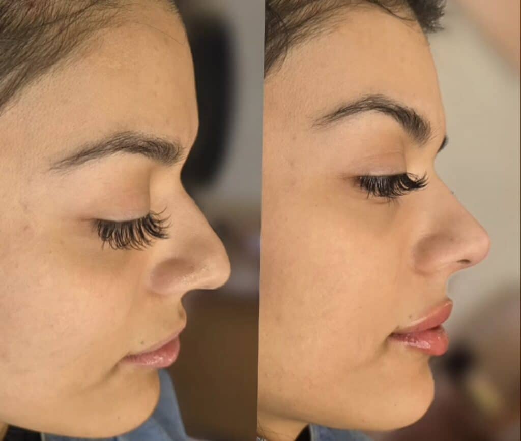 Side-by-side profile photos of the same woman with closed eyes, showing her nose and lips against a blurred indoor background.