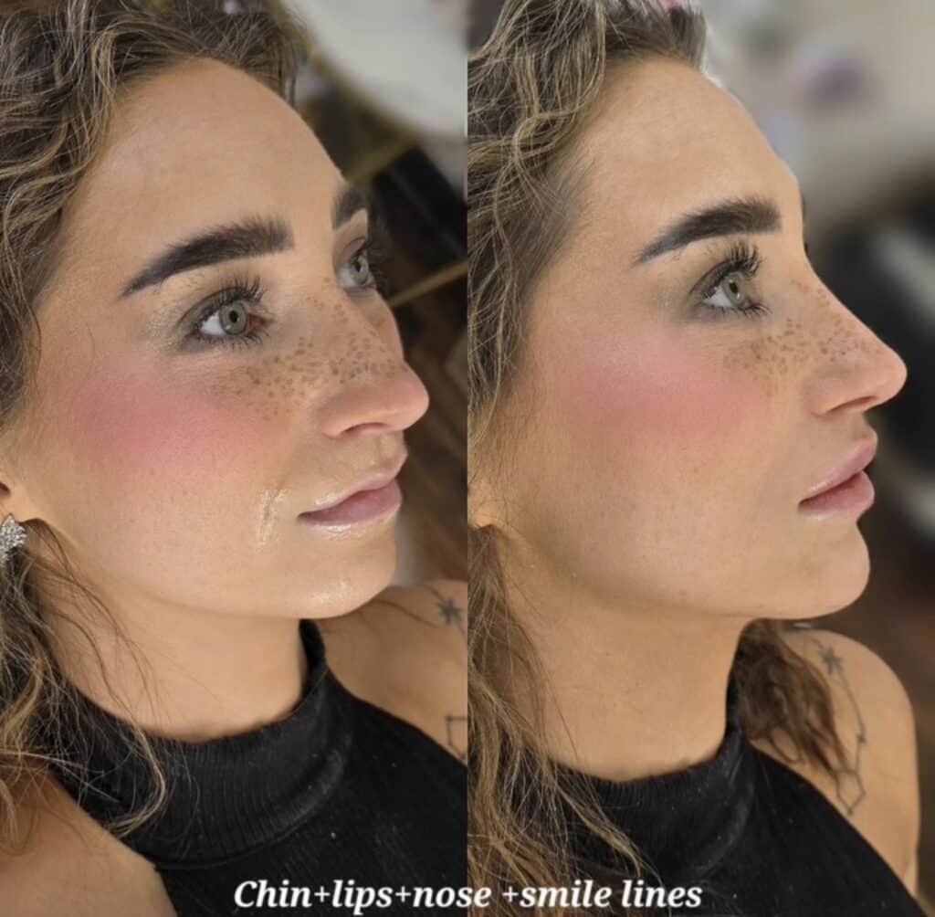 A side-by-side close-up of a woman’s profile showing skin around the chin, lips, nose, and smile lines, with a black sleeveless top and the caption "Chin+lips+nose +smile lines" at the bottom.