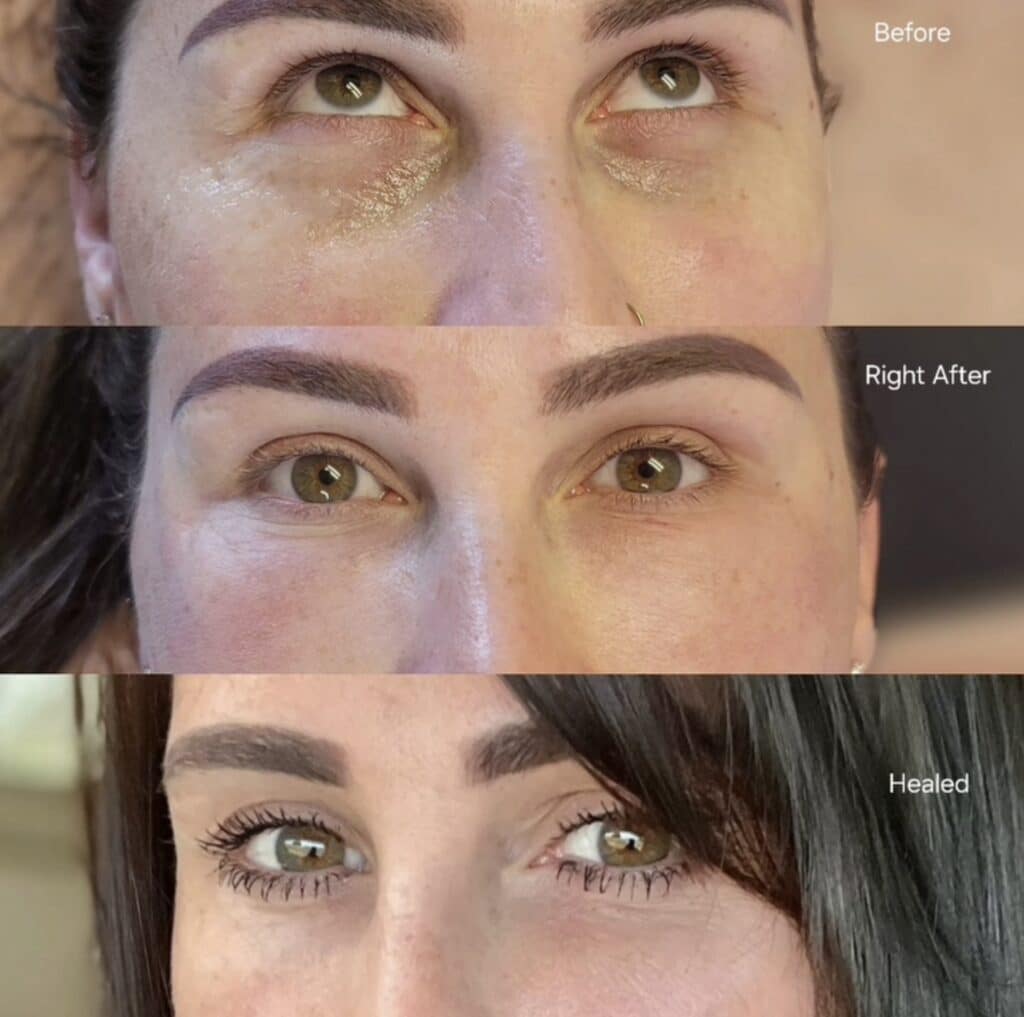Three close-up views of the same woman’s eyes labeled before, right after, and healed, showing reduced under-eye discoloration in the final image.