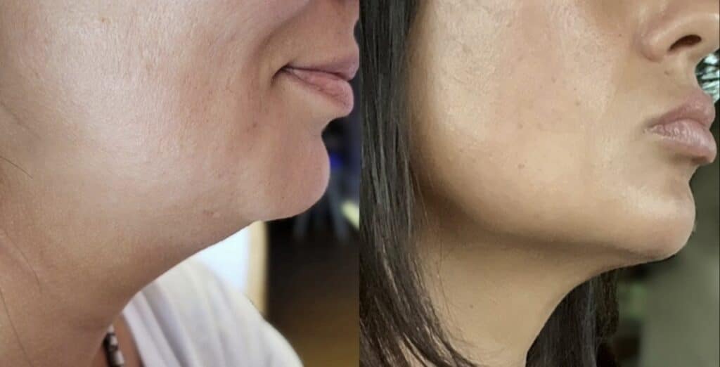 Side-by-side profile close-up of two women’s lower faces and necks, showing a visibly fuller chin on the left and a more defined jawline on the right.