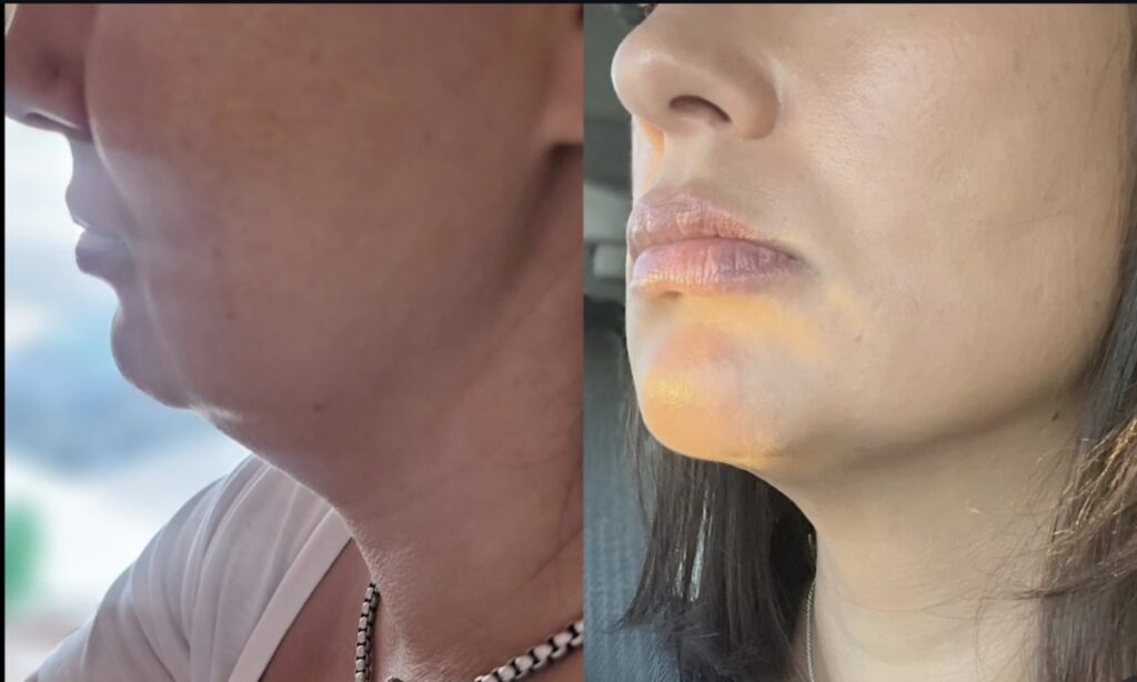 Side-by-side close-up profile views of two women’s lower faces and necks, with visible chin and jawline skin changes on both.