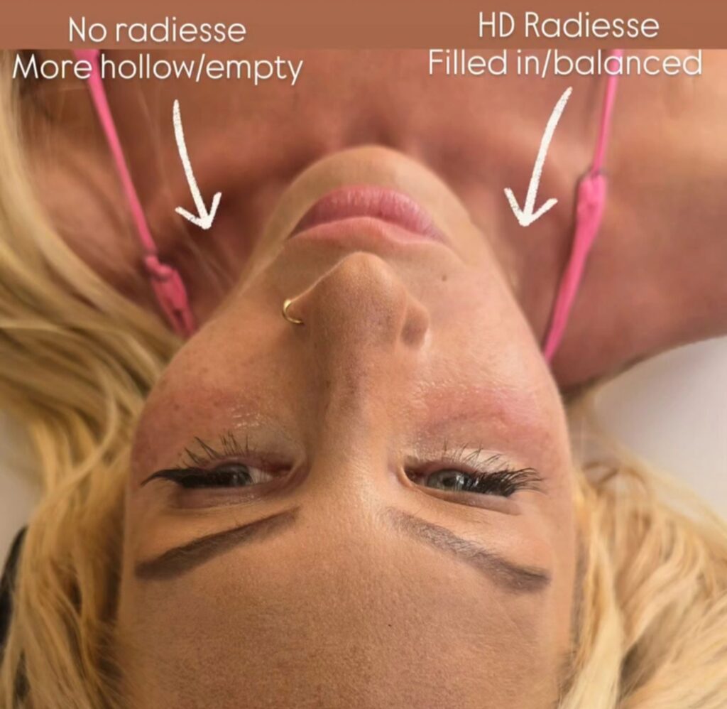 An upside-down close-up of a blonde woman’s face with a nose ring and pink straps, overlaid with arrows and text comparing “No radiesse” on one side and “HD Radiesse” on the other.