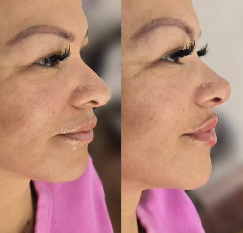 Side-by-side profile photos of a woman in a pink top, showing a facial profile comparison against a blurred indoor background.