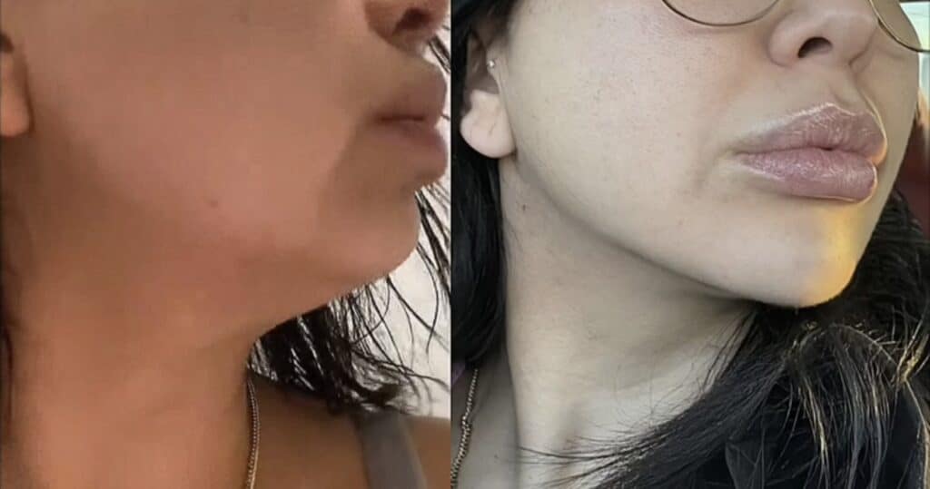 Side-by-side close-up profile photos of a woman's lower face and neck, showing a darker skin tone on the left and a lighter tone on the right.