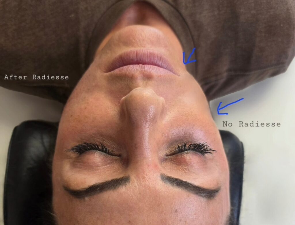 An upside-down close-up of a woman's face on a treatment chair, with blue arrows and the labels 'After Radiesse' and 'No Radiesse' marked on the image.