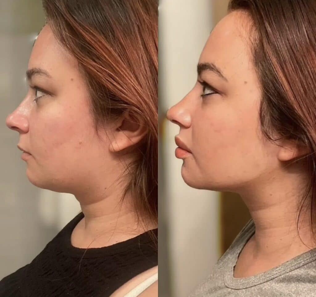 Side-by-side profile photos of a woman before and after a facial profile change, shown against a blurred indoor background.