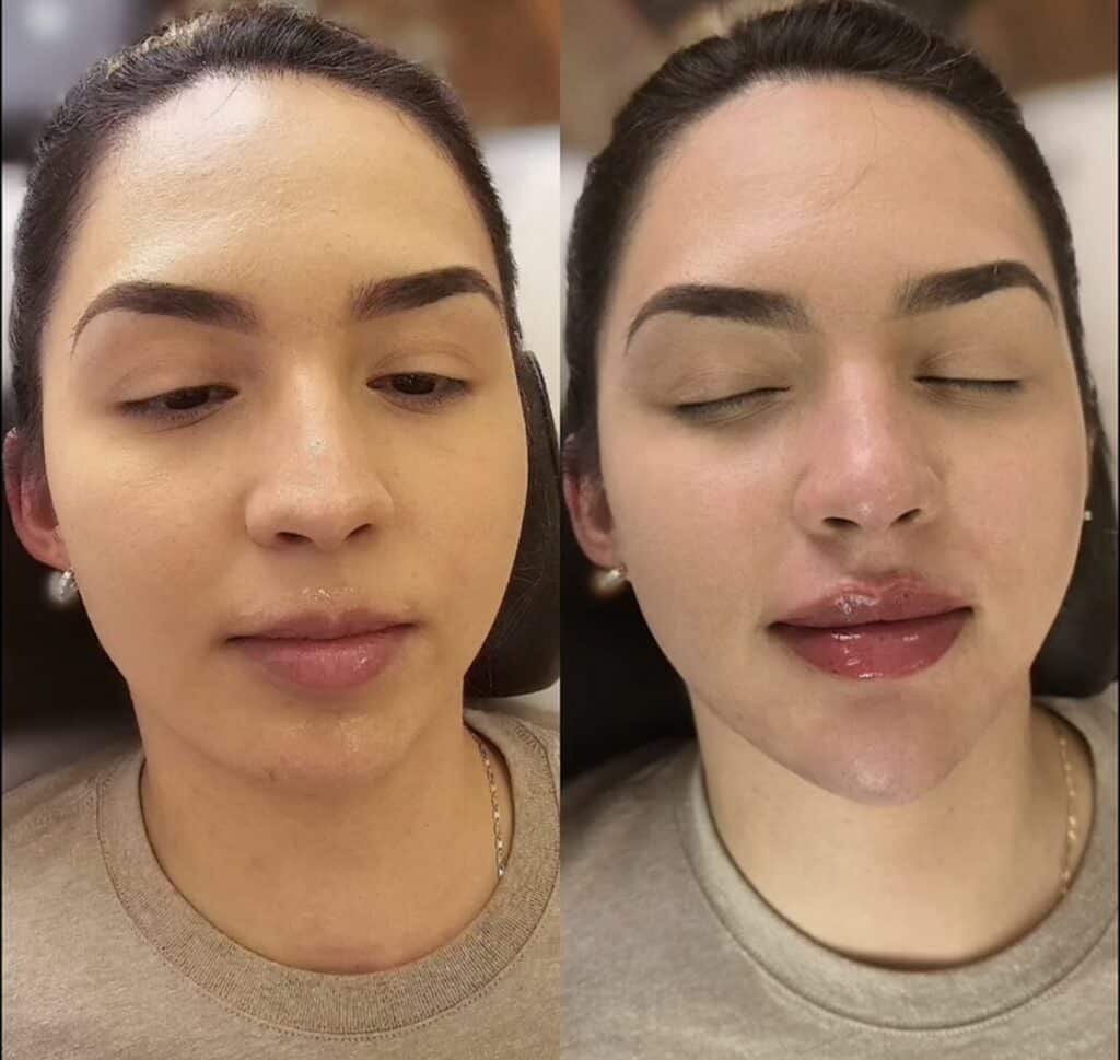 A side-by-side close-up of the same woman’s face before and after lip filler treatment, with a blurred indoor background.