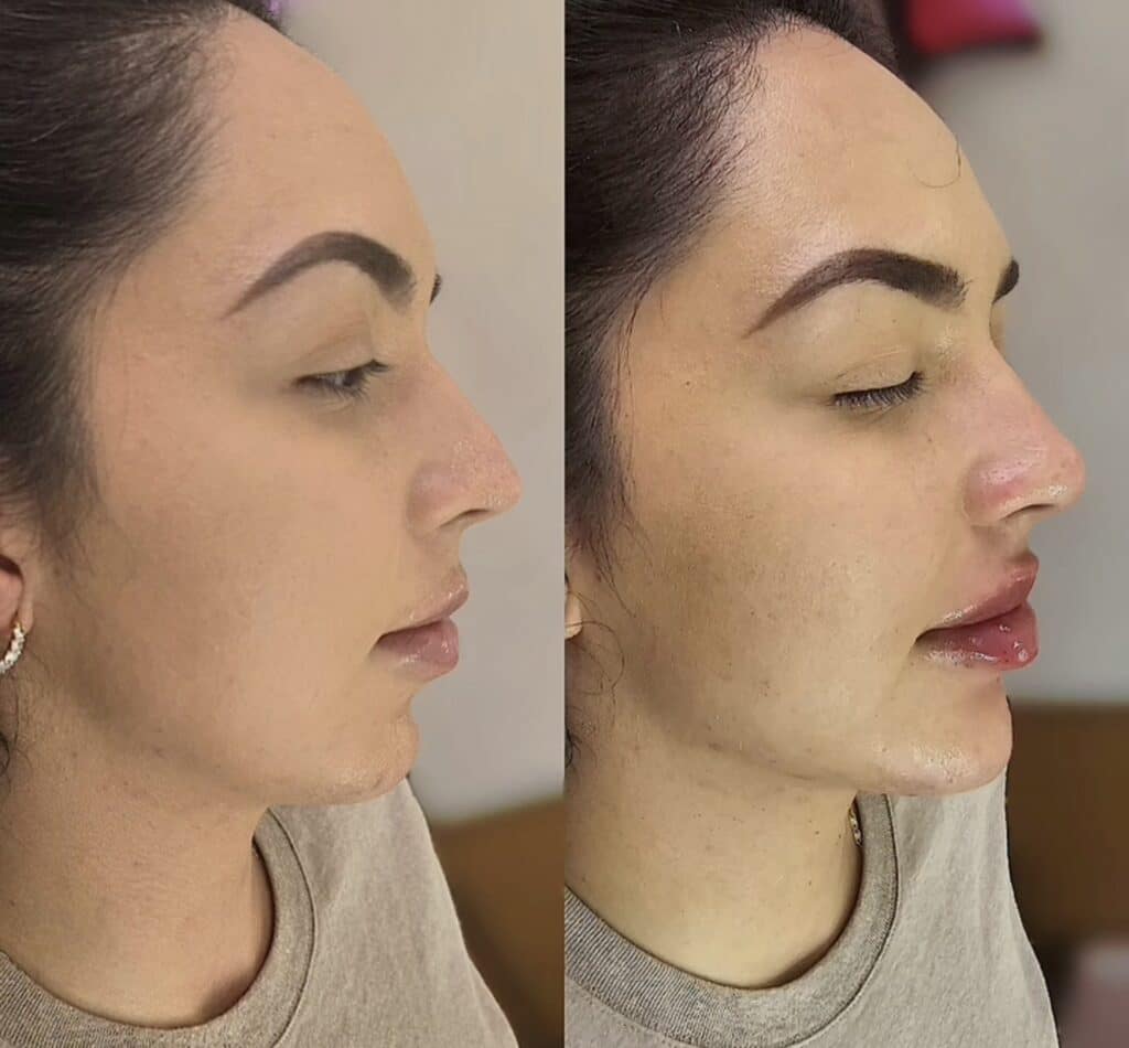 Side-by-side profile photos of a woman with dark hair and defined eyebrows, shown against a plain indoor background.