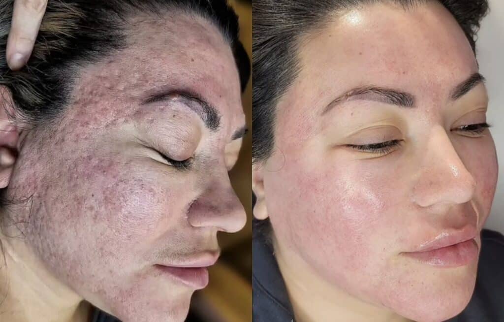 A side-by-side close-up of a woman’s face before and after skincare treatment, showing red, textured skin on the left and smoother skin on the right.