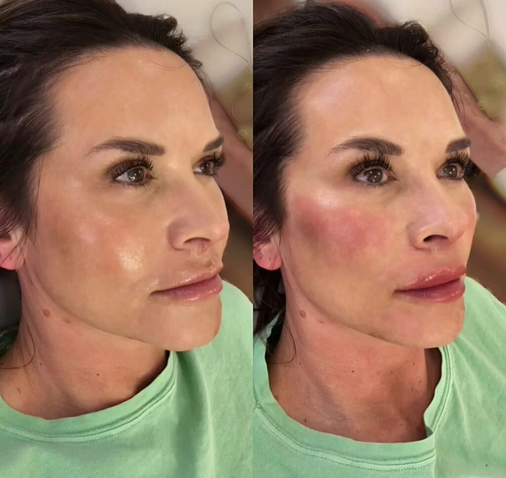 A side-by-side portrait of a woman in a mint green shirt, shown with smoother skin on the left and visibly red cheeks on the right.