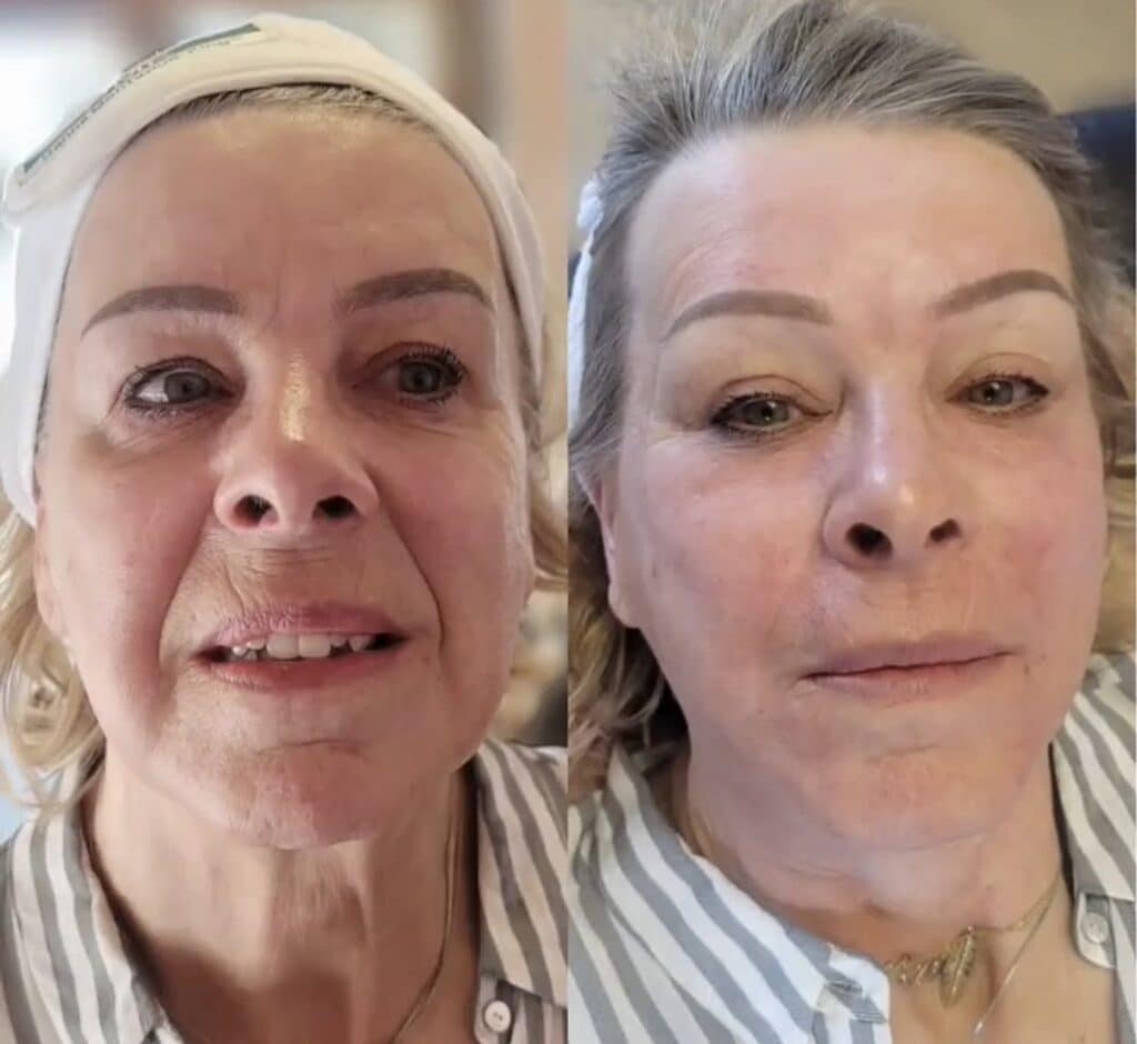 A split-screen close-up shows the same woman before and after cosmetic treatment, wearing a striped shirt, with a white headband on the left and gray hair pulled back on the right.