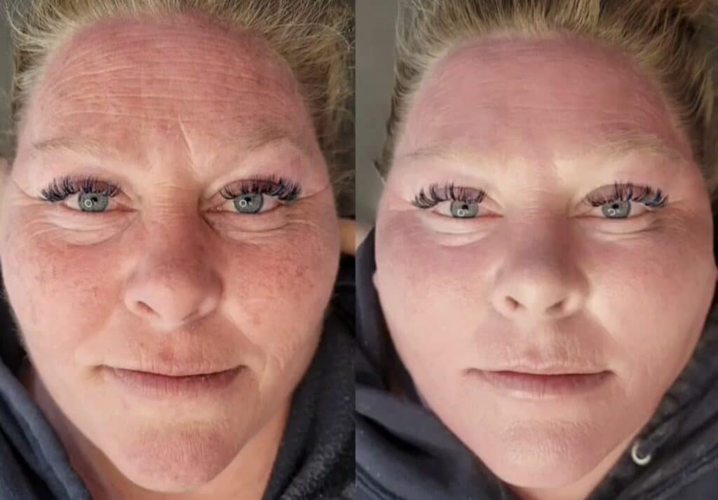 Side-by-side close-up of a woman’s face, showing a before-and-after skin treatment comparison with makeup and a hoodie visible.