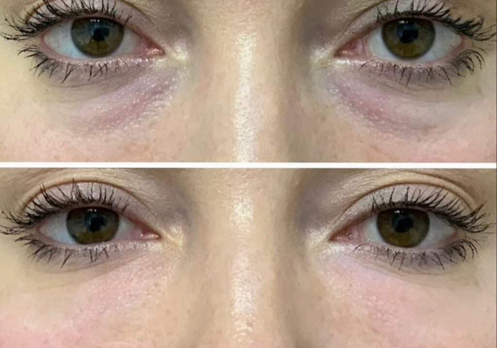 Close-up of a woman’s eyes shown before and after treatment, with the upper image displaying under-eye shadowing and the lower image showing smoother skin.