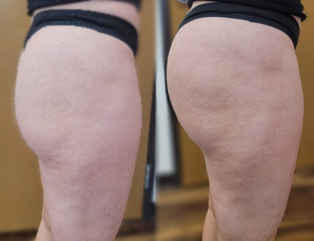 A close-up of two bare thighs side by side, showing skin texture and black elastic bands at the top, with an indoor background.