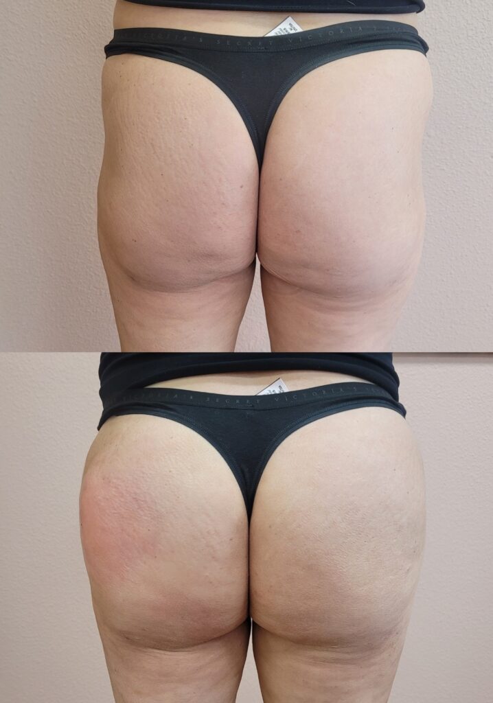 Two stacked rear-view photos show a person wearing black underwear against a plain beige wall, with visible skin texture and a small difference in body shape between the upper and lower images.