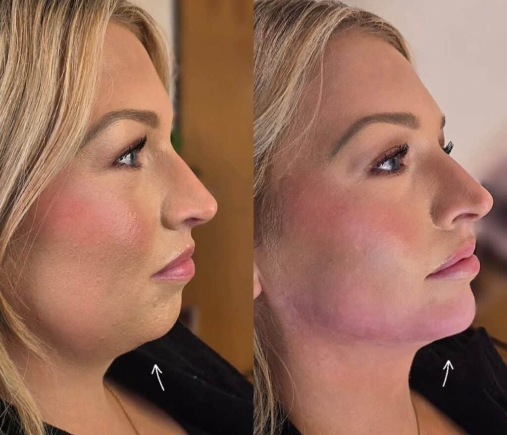 Side-by-side profile photos of a blonde woman, with an arrow marking the jawline in each image.
