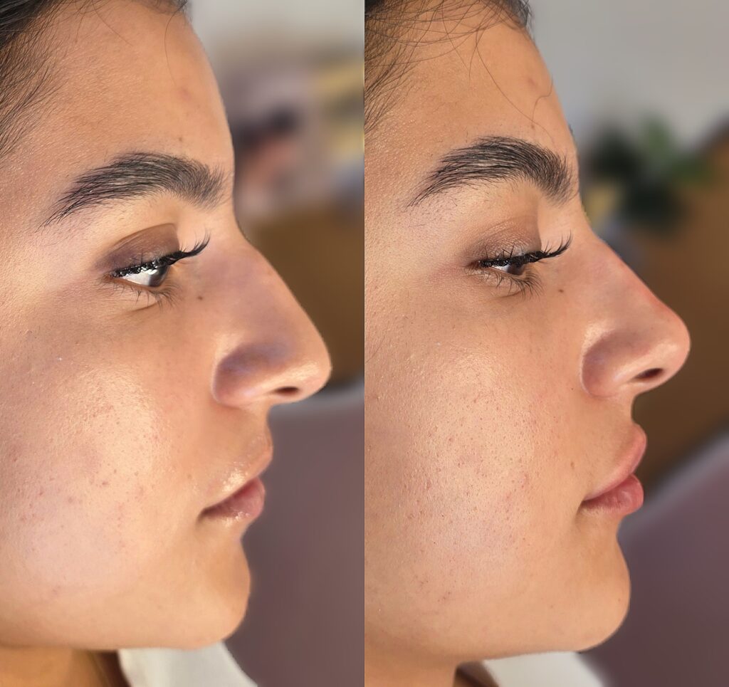 Side-by-side profile photos of a woman’s face showing before and after nose surgery, with a blurred indoor background.