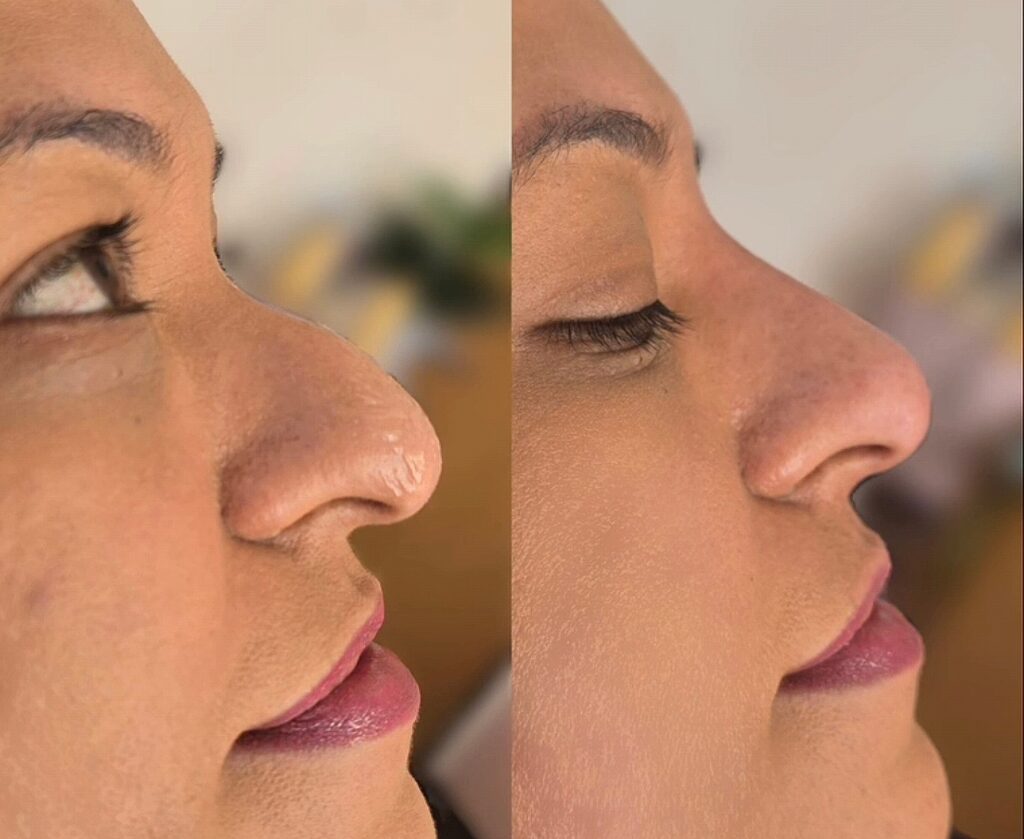Side-by-side close-up profile views of a woman’s face, showing a prominent nose and closed eye against a blurred indoor background.