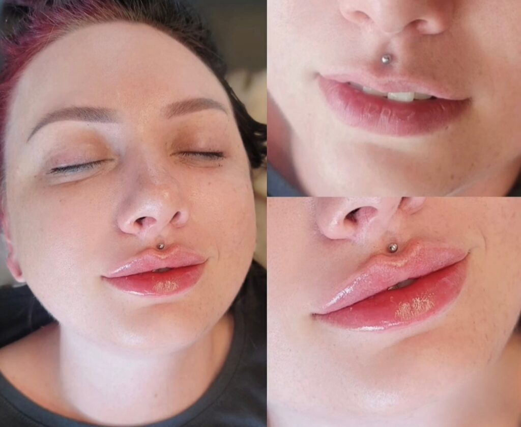 A close-up collage of a woman’s face showing lip filler results, with her closed eyes on the left and close views of her lips and nose piercing on the right.