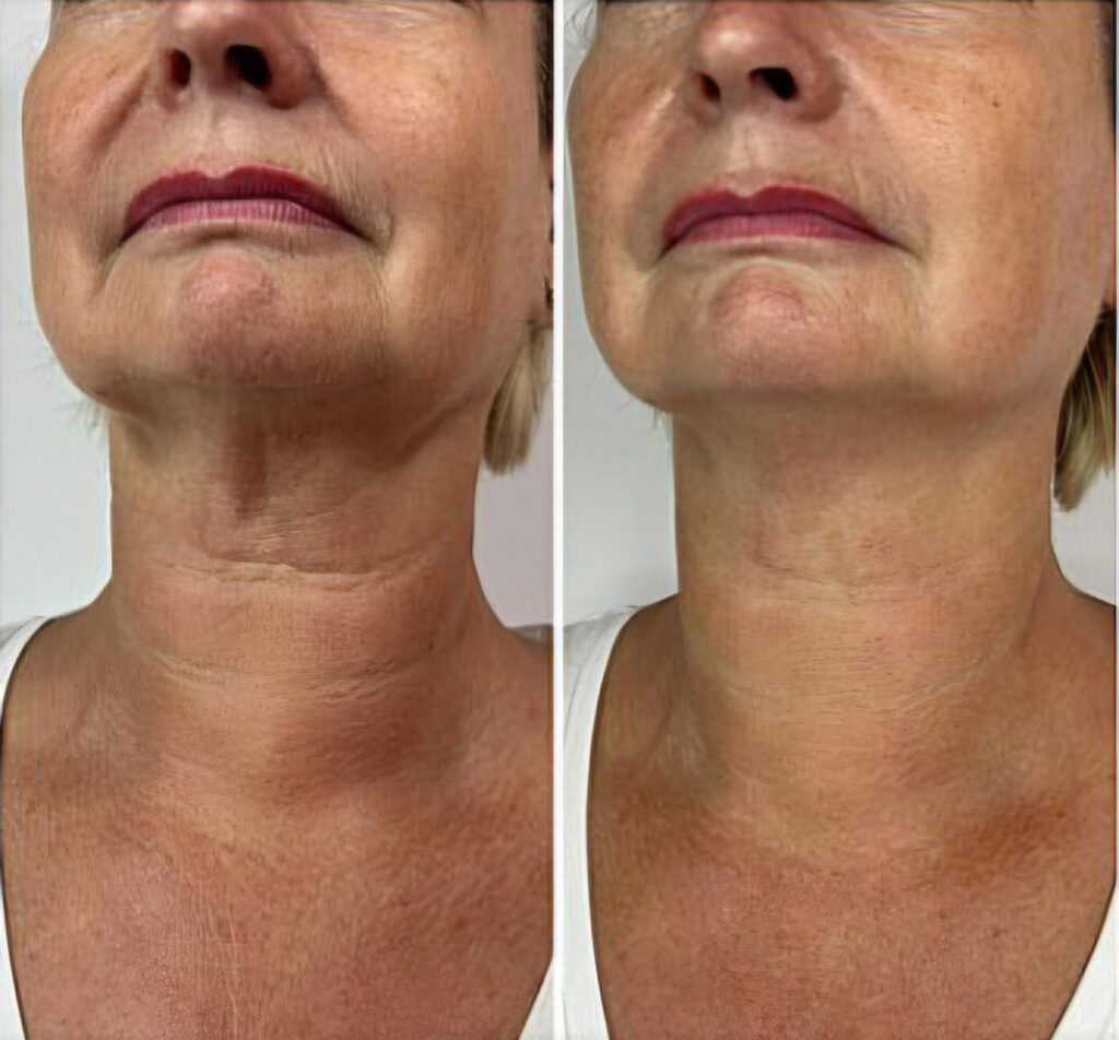 A split before-and-after close-up of an older woman’s lower face and neck, with the left side showing more neck lines and skin texture than the right.
