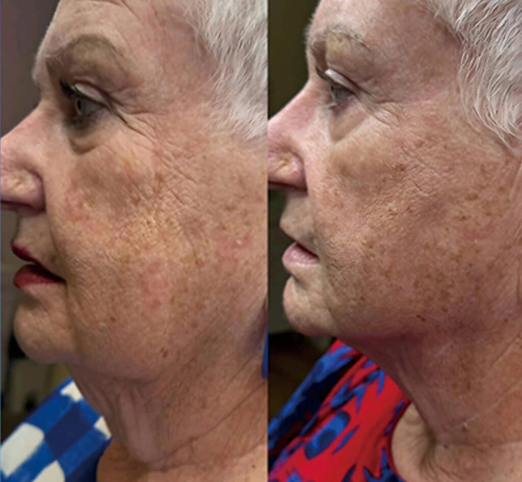 Side-by-side profile photos of an older woman with short gray hair, showing a close-up of her face and neck against a plain background.