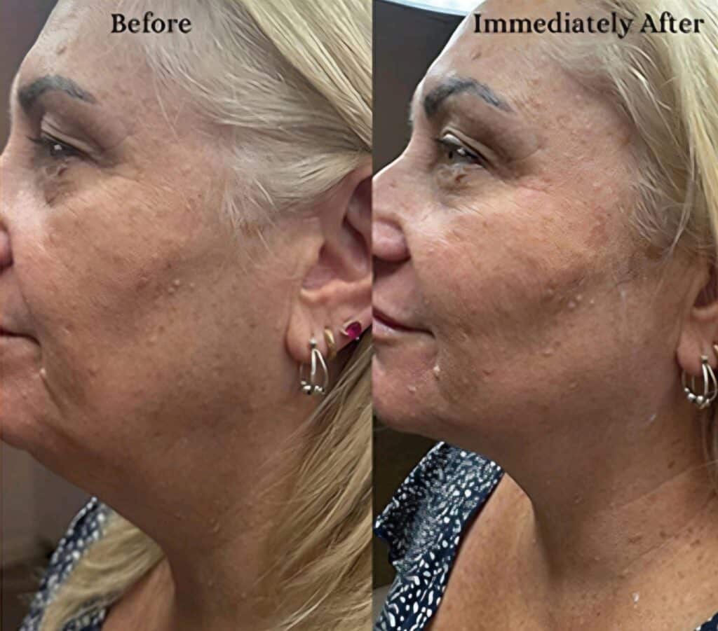 Side-by-side profile photos of a blonde woman labeled before and immediately after, showing changes in her facial skin texture against a dark background.