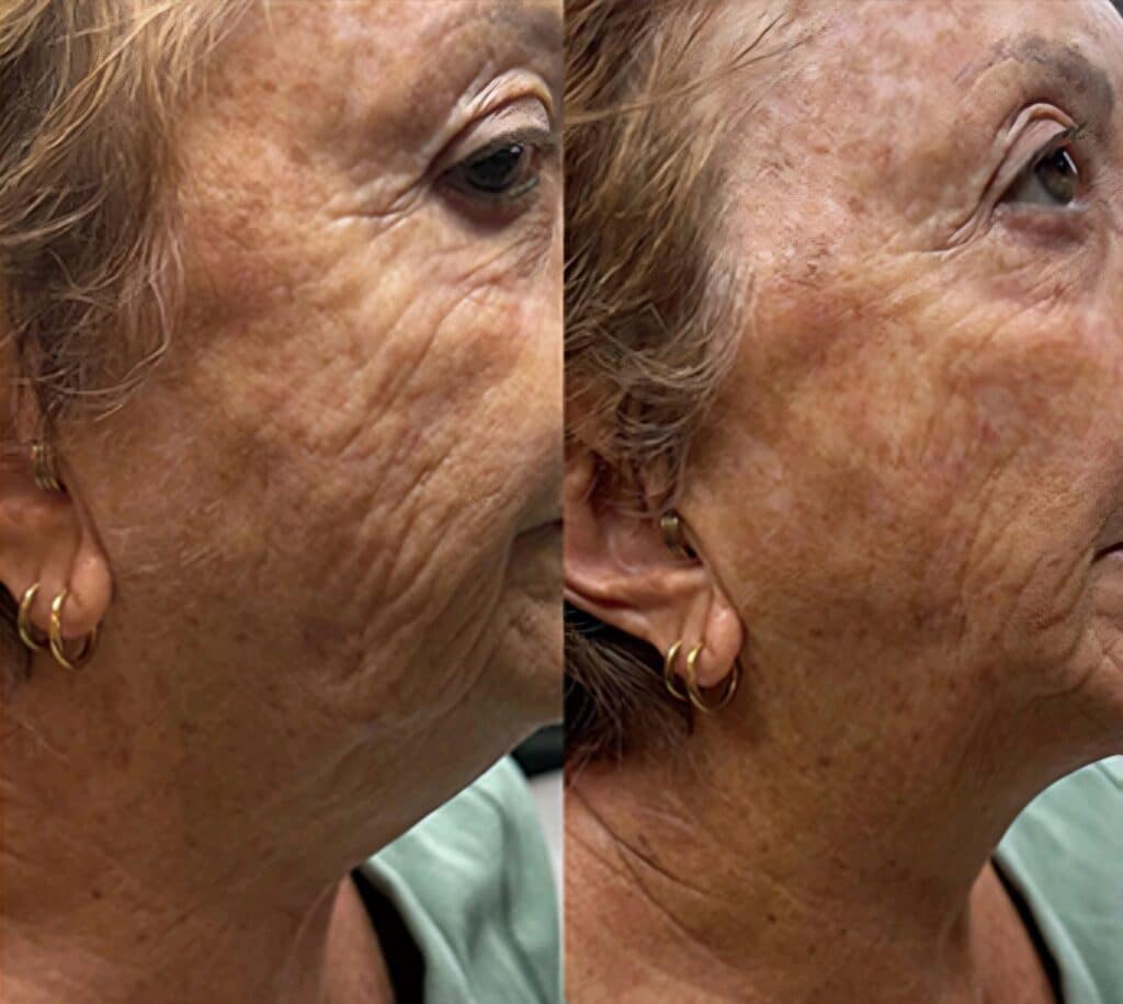 Side-by-side profile close-ups of an older woman’s face, showing facial skin before and after treatment, with a light green top visible at the bottom.