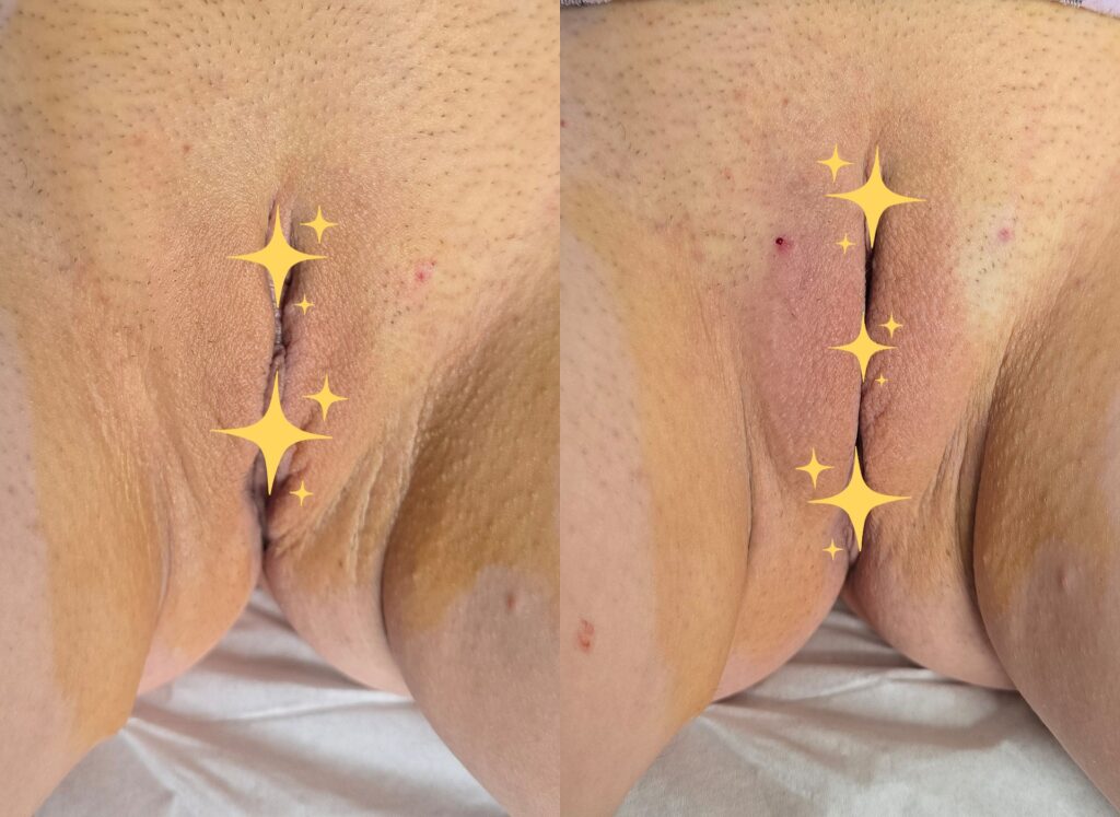 Side-by-side close-up of skin folds on a body, with star stickers covering the center area and a white sheet in the background.