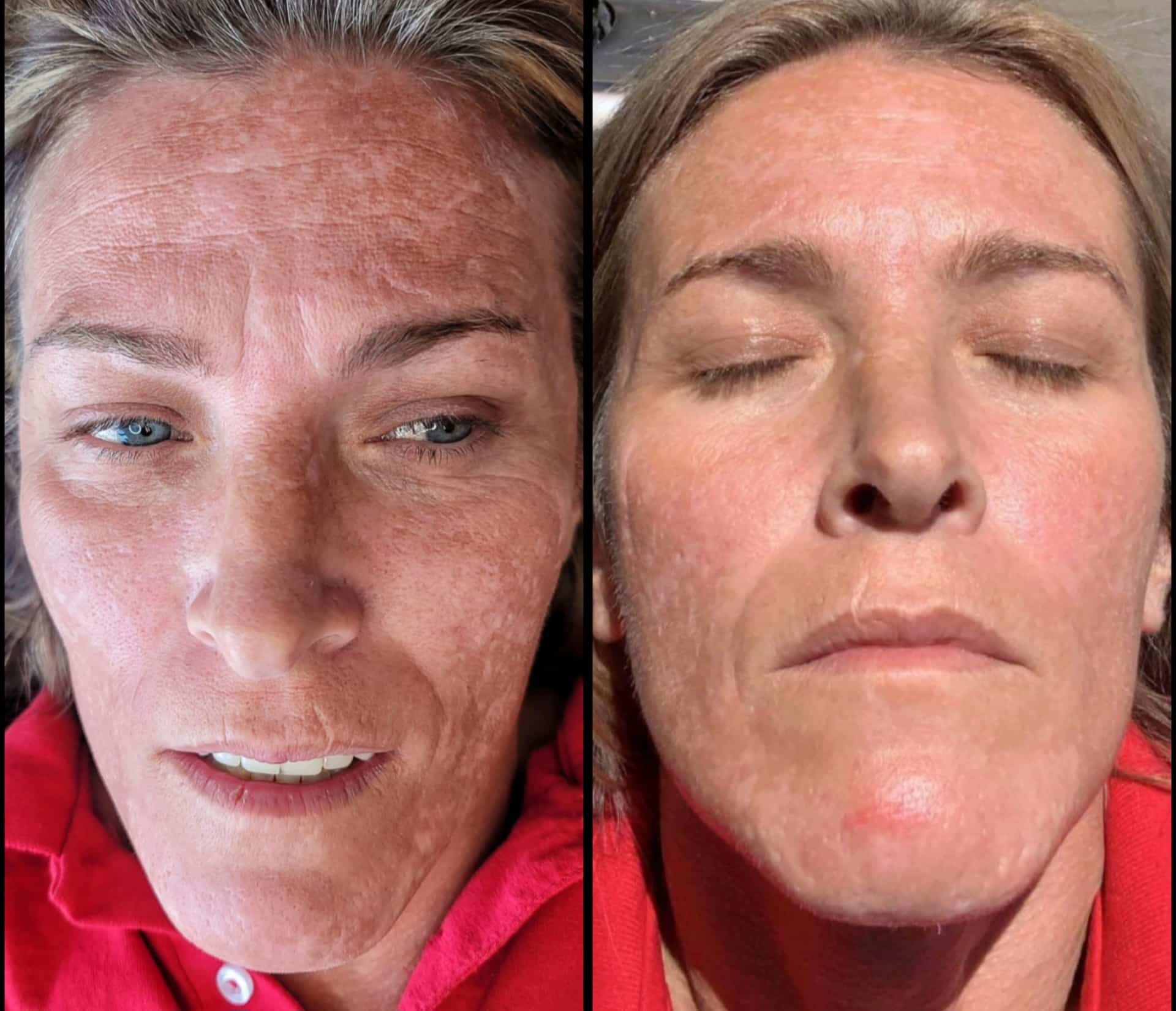 A close-up before-and-after portrait of a woman with light skin in a red shirt, shown in two side-by-side vertical panels.