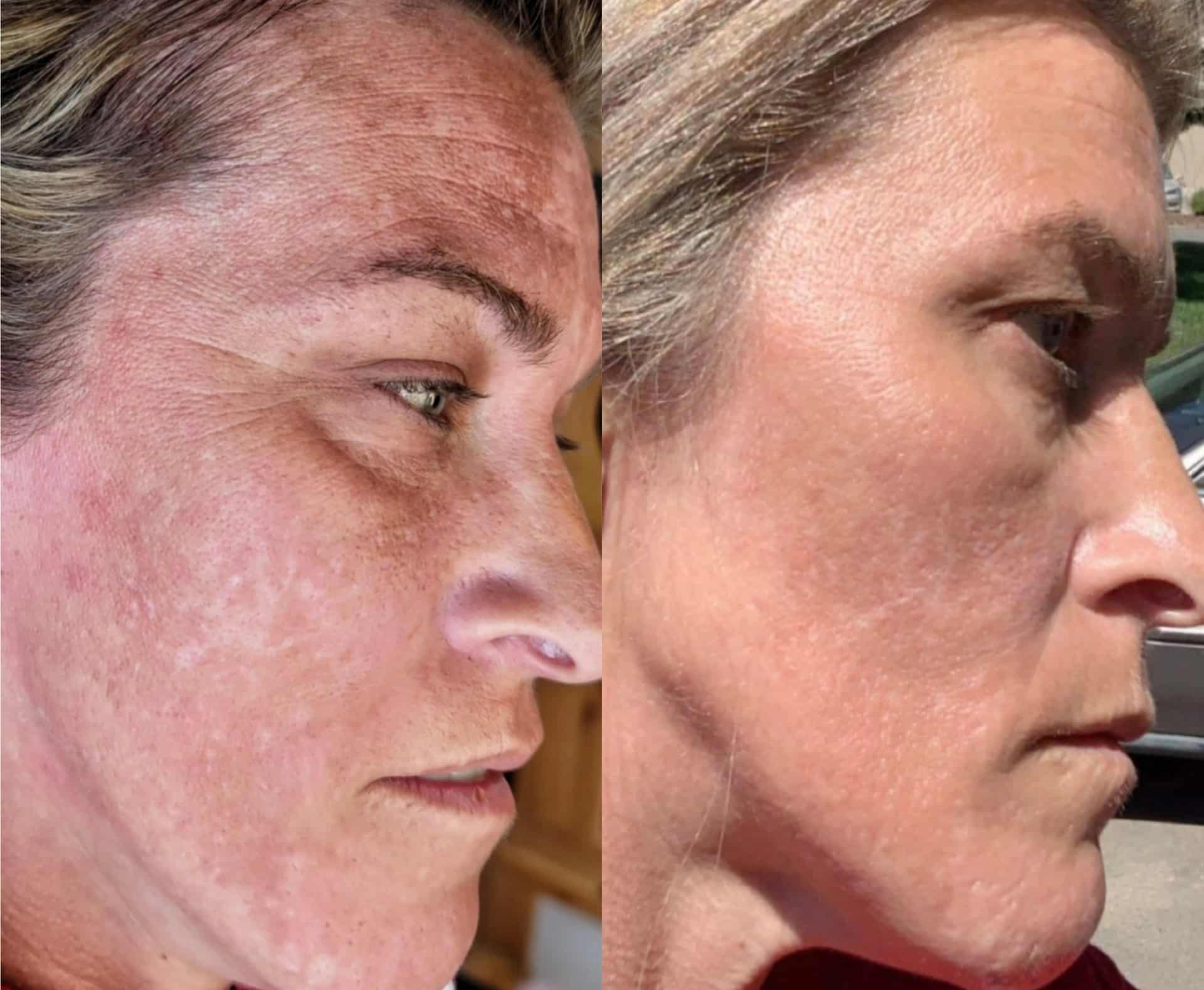 Side-by-side profile photos of a woman showing skin before and after treatment, with a lighter, smoother complexion on the right.