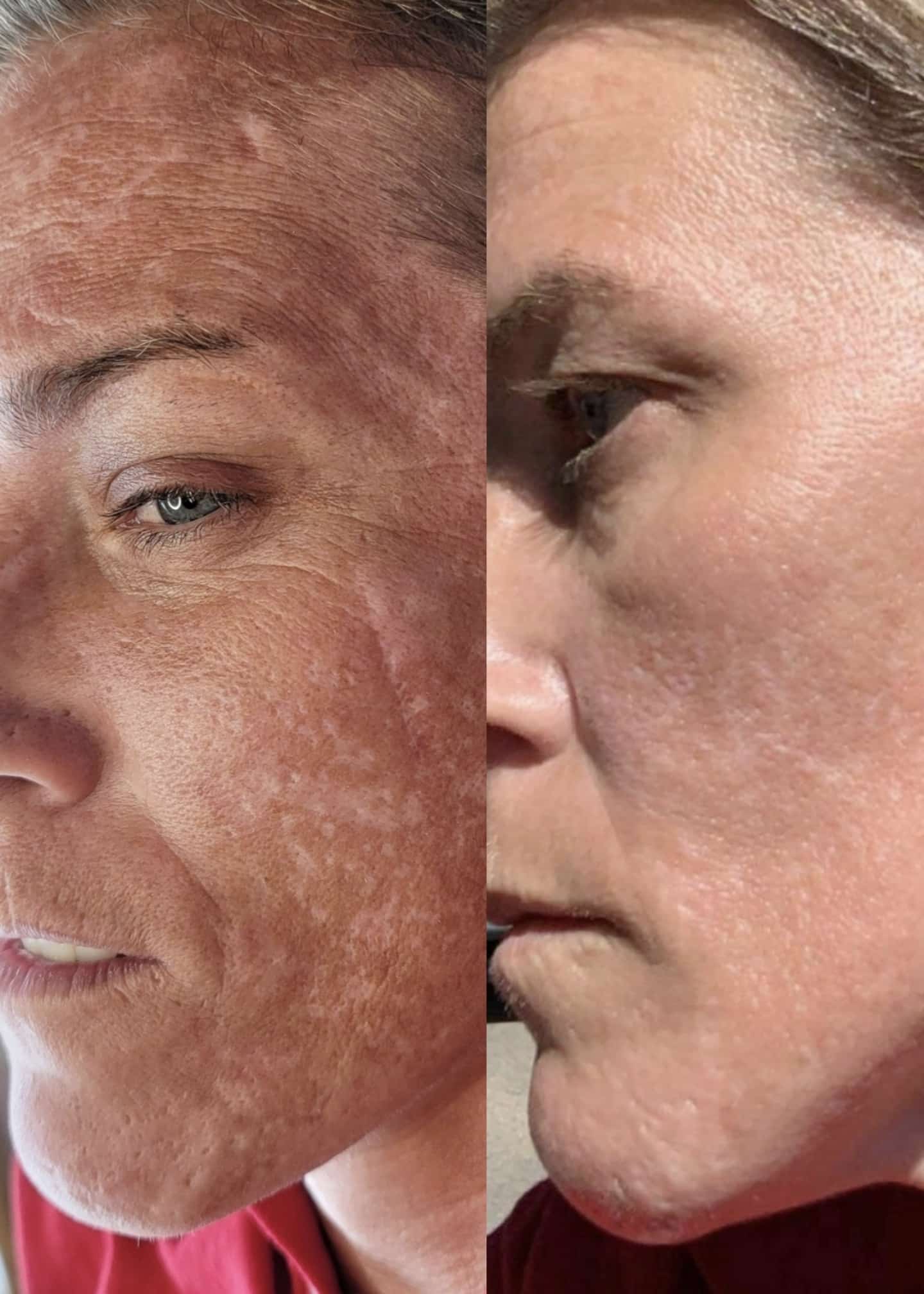 Side-by-side close-up profile views of a woman’s face showing skin texture and redness, with one side more evenly lit than the other.