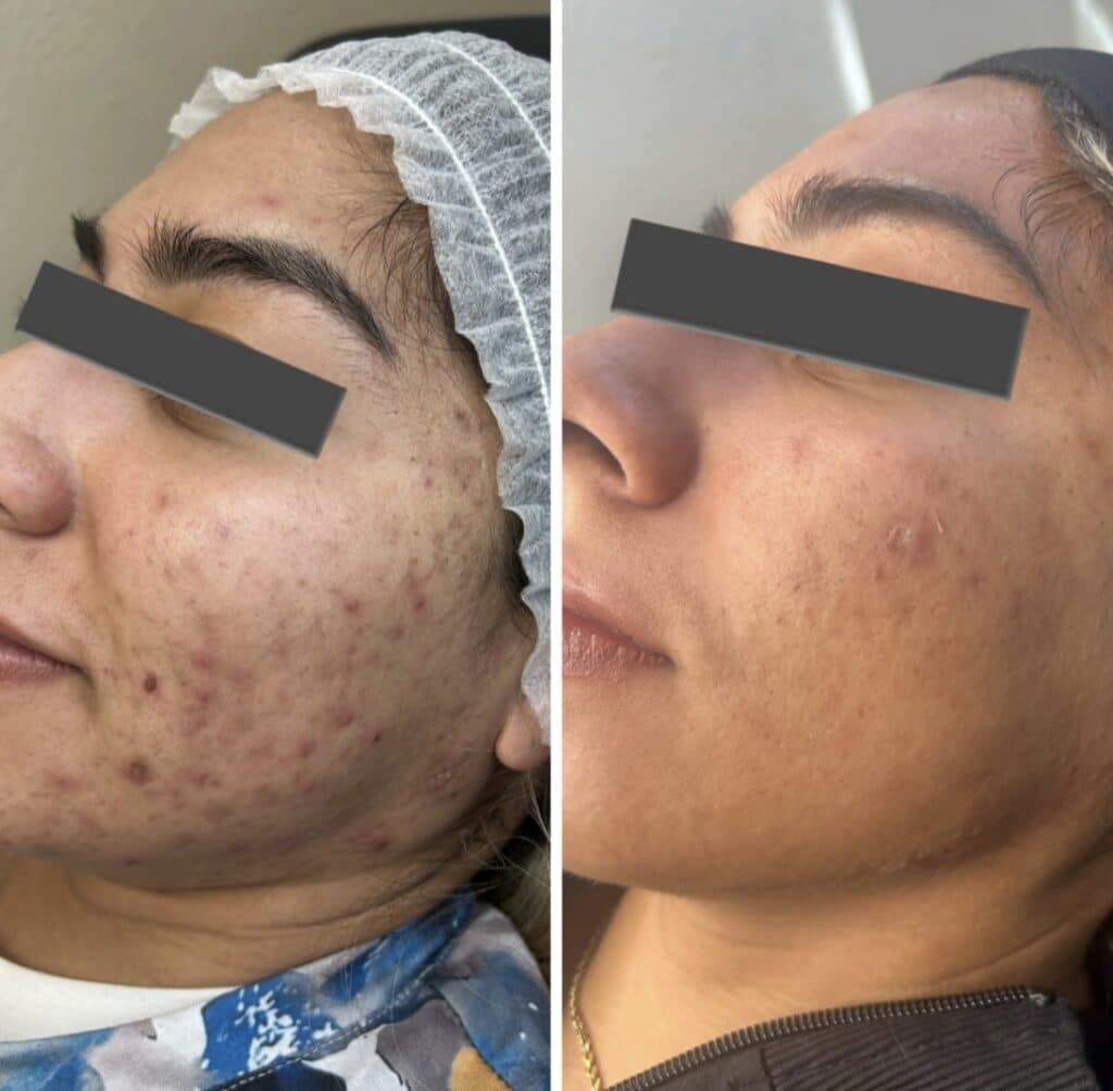 Side-by-side close-up of the same woman's face showing acne before and after treatment, with a hair cap on the left image and smoother skin in the right image.