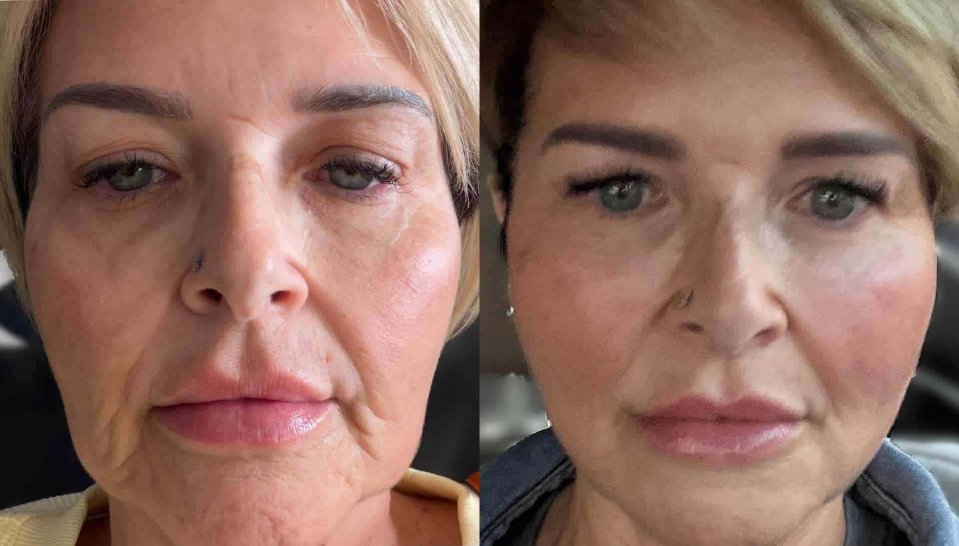 A side-by-side close-up of the same woman’s face before and after treatment, showing smoother skin and reduced wrinkles.