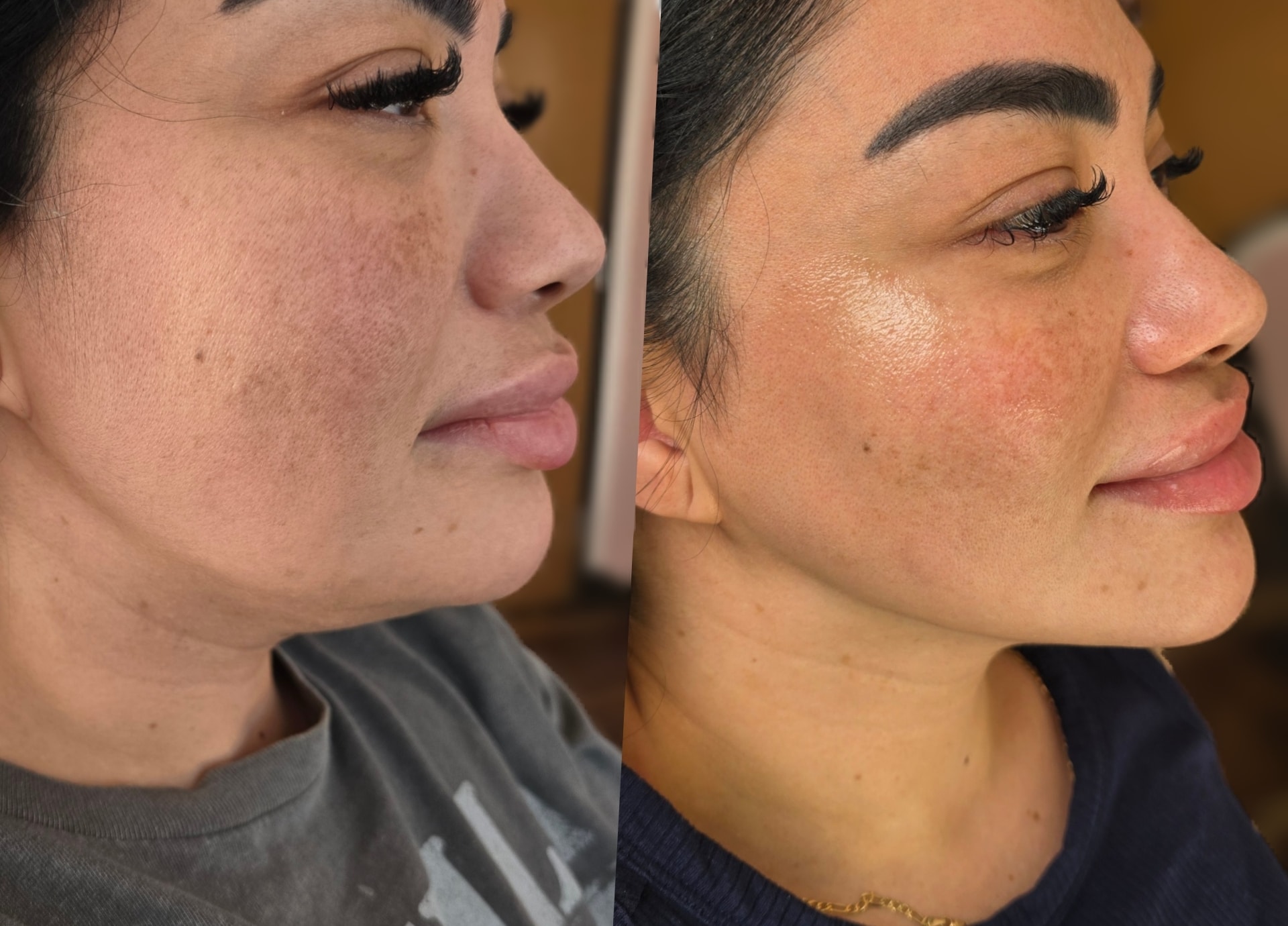 Side-by-side profile photos of the same woman, showing blemished skin on the left and smoother skin on the right.