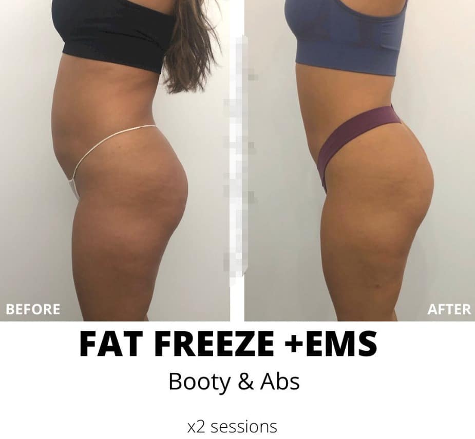 Side-by-side before and after photos of a woman's torso and hips in workout shorts, with text reading “FAT FREEZE +EMS,” “Booty & Abs,” and “x2 sessions.”