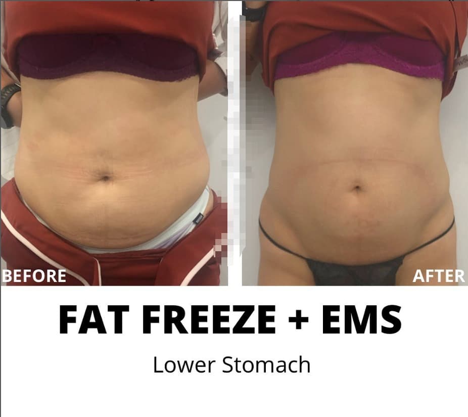 Before-and-after comparison of a lower stomach, showing a before image on the left and an after image on the right above the text “FAT FREEZE + EMS” and “Lower Stomach.”