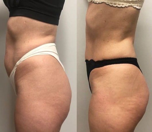 Side-by-side profile photos of a woman’s torso and hips wearing underwear, showing a fuller figure on the left and a slimmer figure on the right against a plain background.