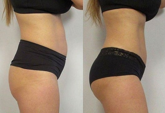 Side-by-side before-and-after view of a woman’s midsection and hips in black underwear against a plain light background.
