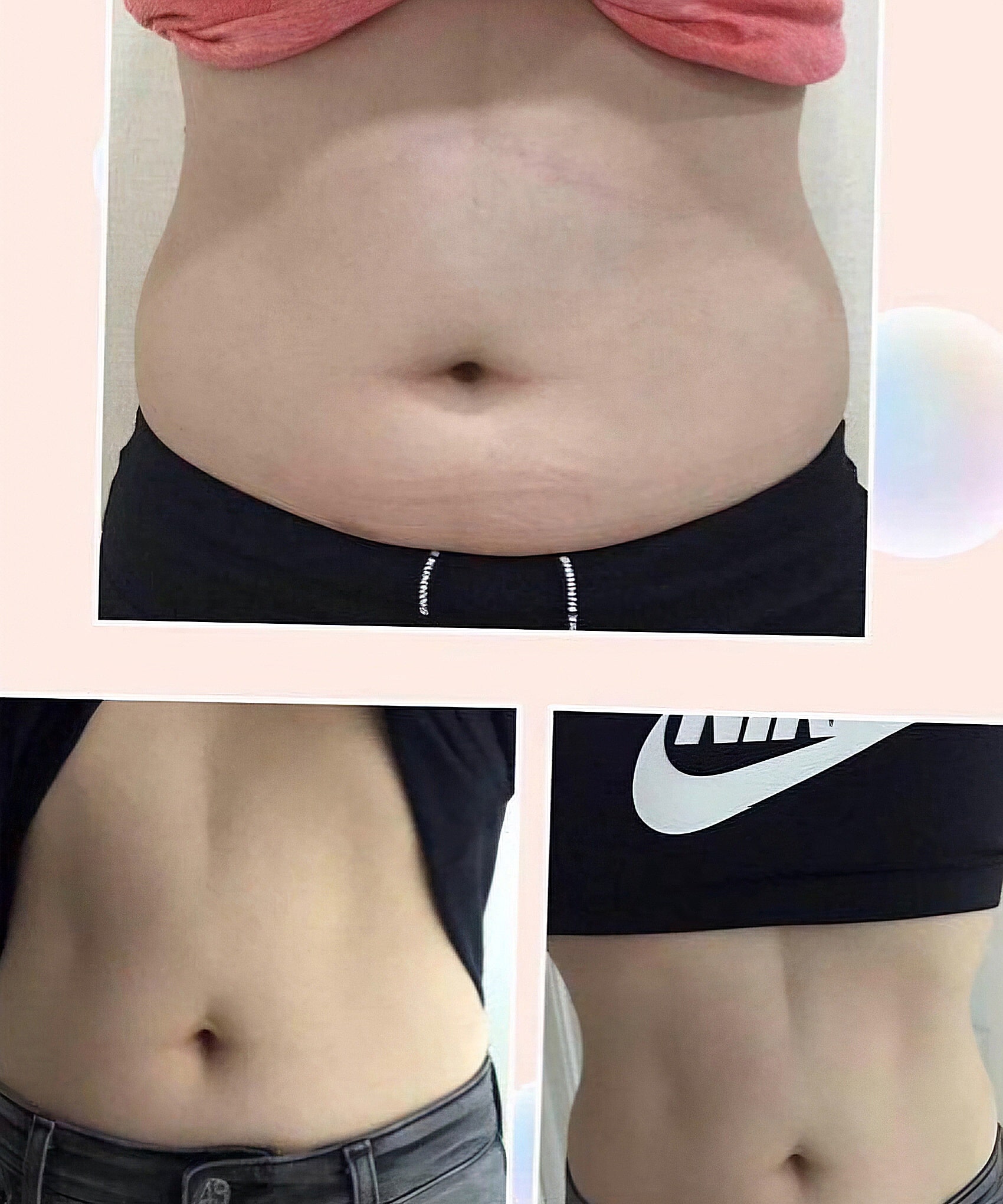 A three-panel collage shows a person’s midsection before and after weight loss, with the abdomen against plain indoor backgrounds.