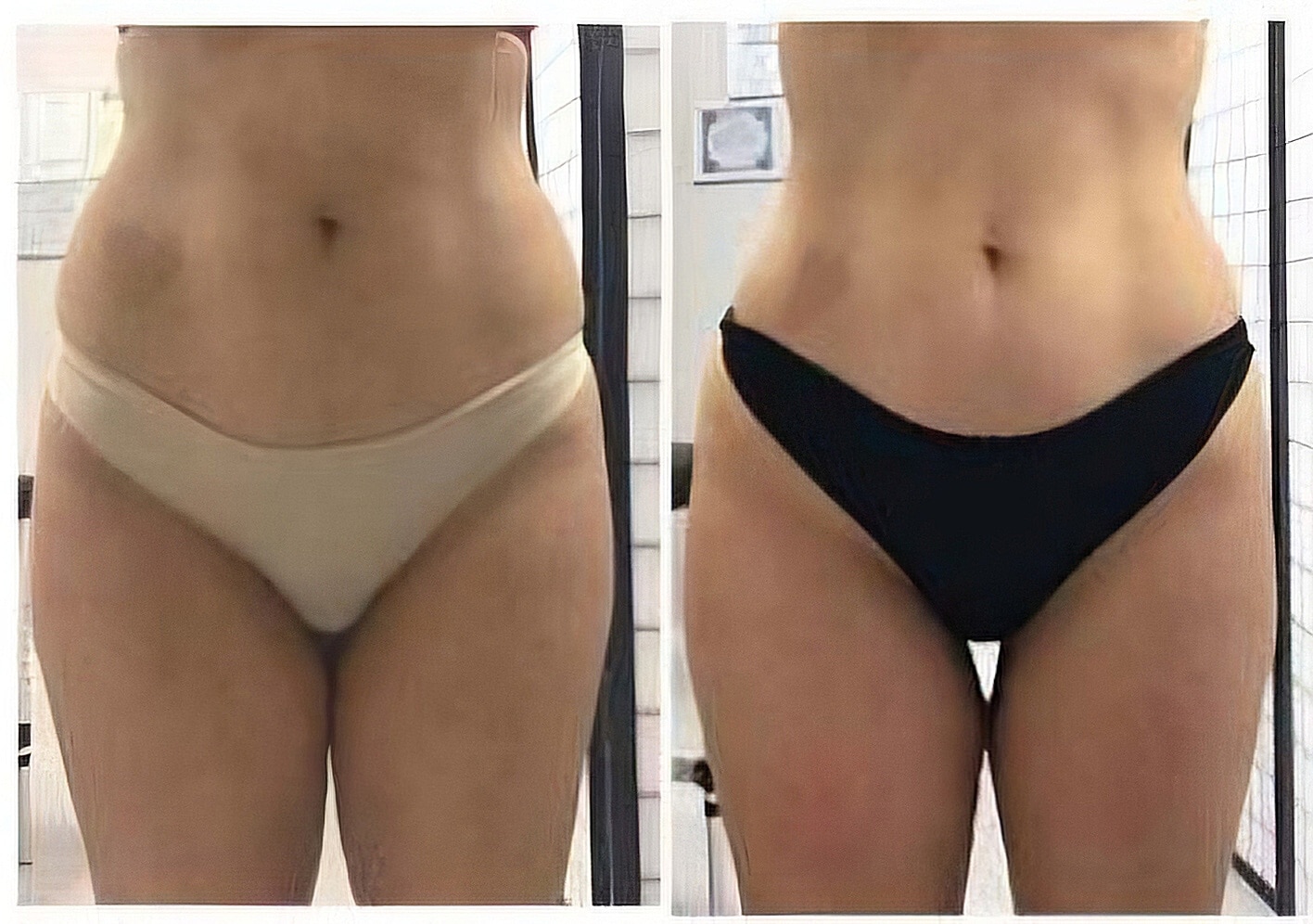 Side-by-side photos show a woman’s torso and hips in beige and black underwear against a tiled indoor background.