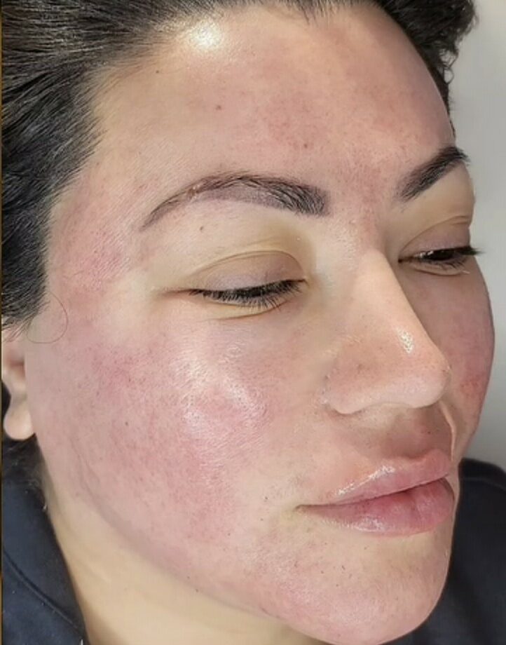 Side-by-side close-up of a woman’s face before and after skincare treatment, showing acne-prone skin on the left and smoother skin on the right.