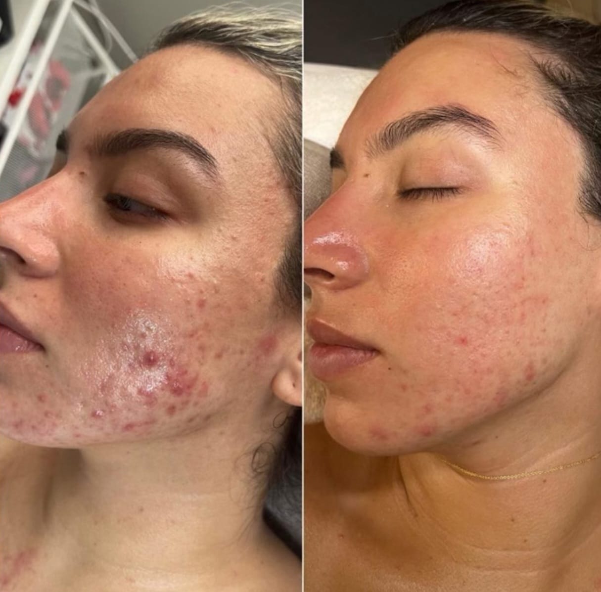 A side-by-side close-up of the same woman's face shows acne-prone skin before and after treatment, with a pillow visible in the background.