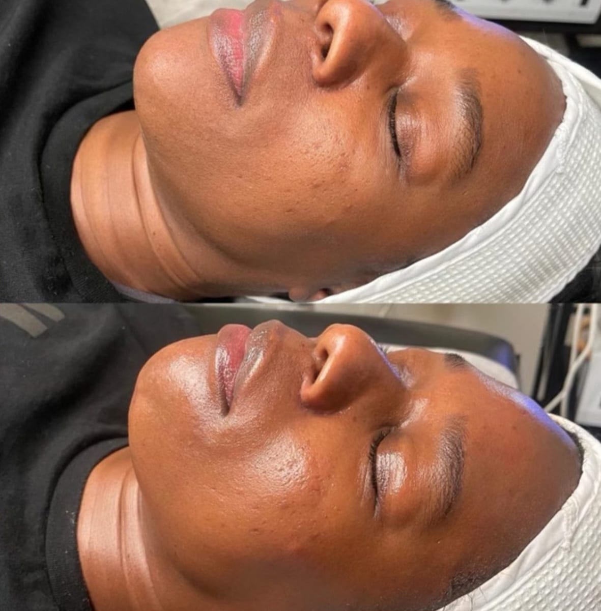 Two close-up side-profile photos show a woman's face with eyes closed, wearing a white headband, on a treatment table.